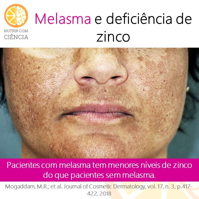 Melasma e zinco